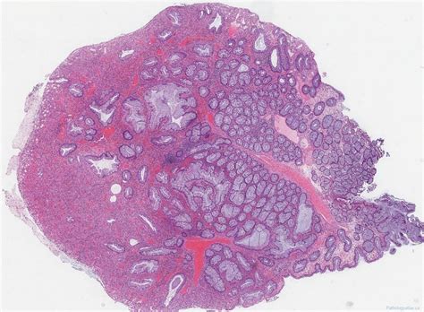 Inflammatory Type Polyp Of The Colon Atlas Of Pathology