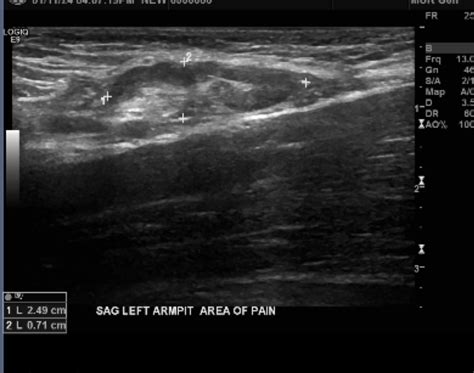 Enlarged Lymph Node In Armpit Raskdocs