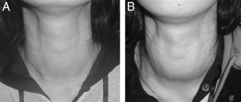 Overt Paroxysmal Thyroid Swelling Photos Of The Patient Taken Without