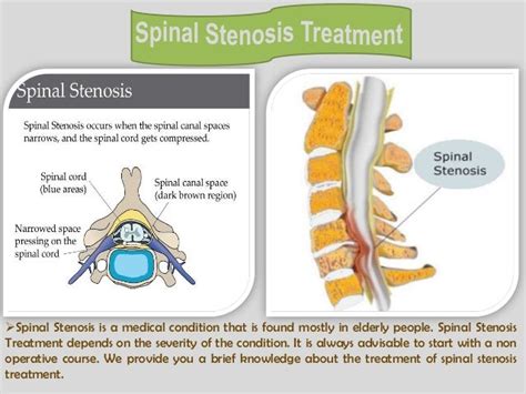 Lumbar Spinal Stenosis Surgery
