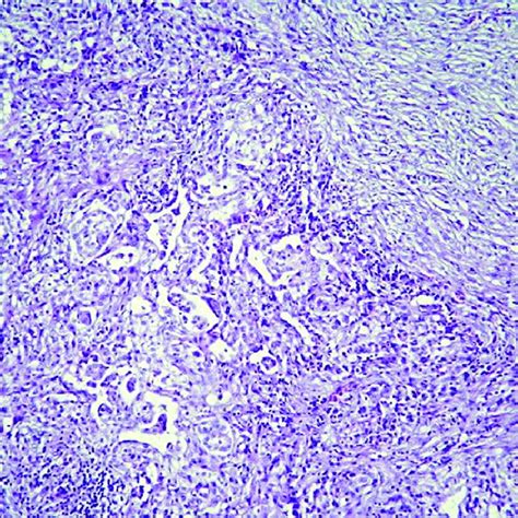 Benign Mesothelial Cell Proliferation Shows Bland Cuboidal Cells He