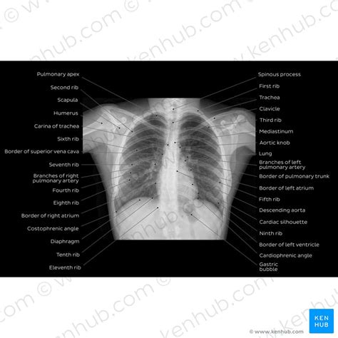 Anatomy Of Chest X Ray Normal Chest X Ray Anatomy Tutorial Kenhub