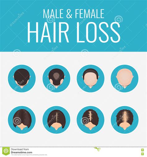 Stage 3 vertex — this stage refers to hair loss occurring predominantly at the top of head, but stage 6 — both areas of noticeable hair loss have now joined. Female Pattern Hair Loss Stages Cartoon Vector ...