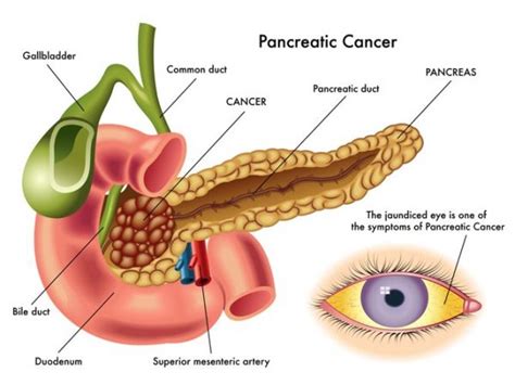 Pancreatic Cancer Florida Center For Pancreas Diseases