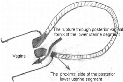 Diagrammatic Figure Showing The Rupture Through Posterior Vaginal Download Scientific Diagram