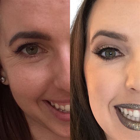 Botox is a safe and effective treatment that can last 3 to 4 months. All About Botox | Botox before, after, Botox eyes, Botox ...