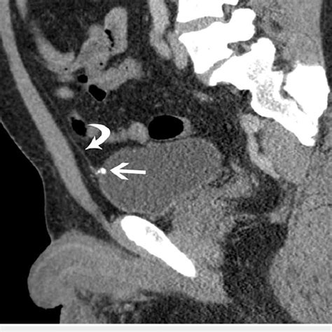 Sagittal Reformatted Image From Ct Scan Shows Cord Like Midline