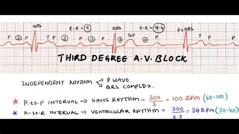 Third Degree Heart Block Complete A V Block Ecg Interpretation Of