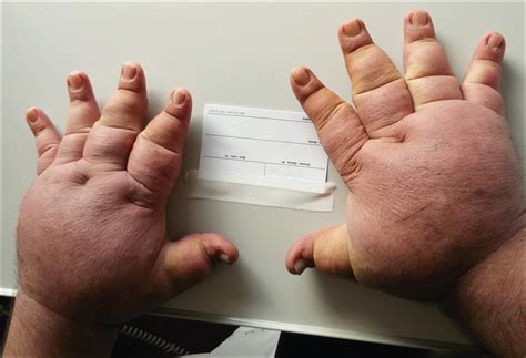 Puffy Hand Syndrome The Lancet
