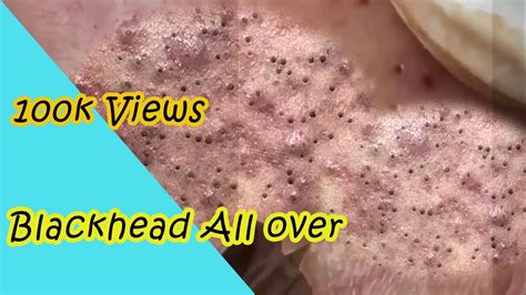Omg Removal Of Extreme Blackhead Never Seen Before Part 1 😱😱 Youtube