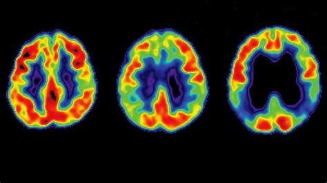 Alzheimers Disease Stages And How They Progress