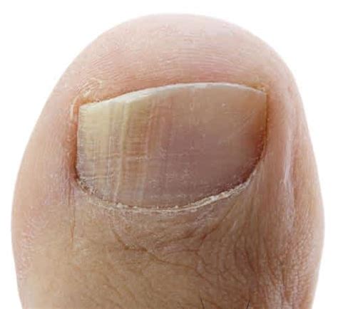 Inflamed And Swollen Nail Bed Toenail Coming Off Or Toenail Fungus