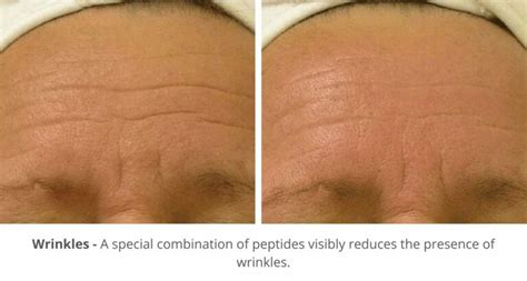 Hydrafacial Before And After Photos London Premier Laser And Skin Clinic