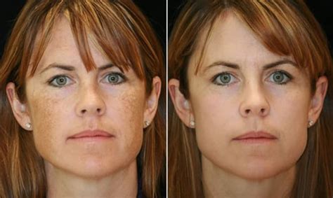 How much does revlite laser treatment cost? Dermatologist for acne near azle tx, freckle removal cost ...