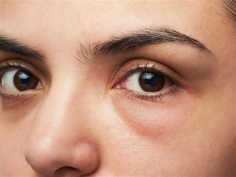 These Are The Reasons You Have Puffy Under Eyes Musely