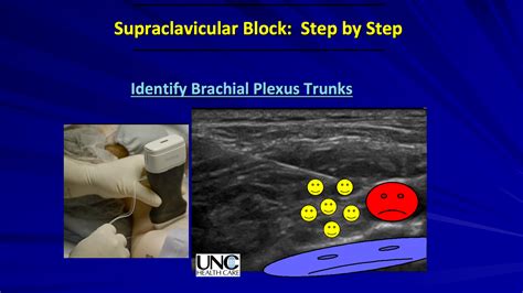 Video Is The Supraclavicular Plexus Block The Right Choice To Prevent