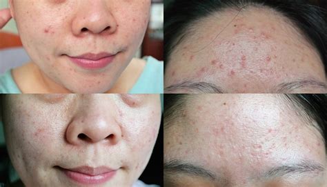 Cystic Hormonal Acne Treatment With Kiehls Singapore Beauty Products