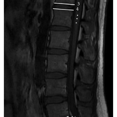 A Iliolumbar Ligament Arrow Was Used To Identify L5 Vertebra B