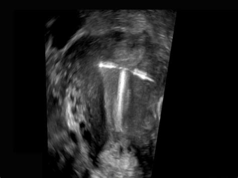 Gynaecology Scans Ultrasound Women Scans Ireland