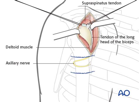 Anterolateral Approach To The Proximal Humerus