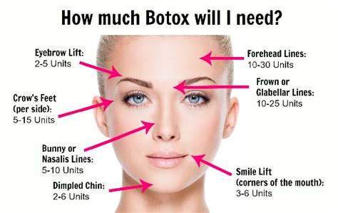 5 Things You Should Know Before Your Botox Appt Dream Dental Blog