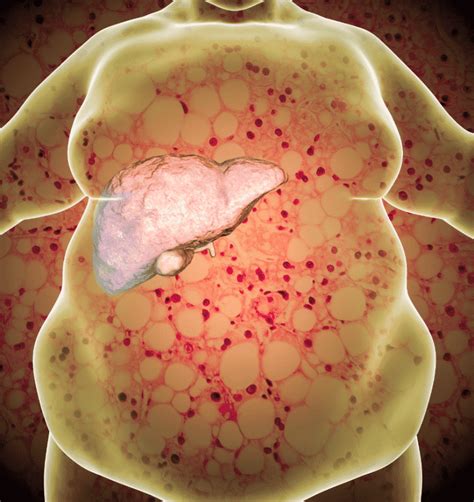 Fatty Liver Signs Symptoms And The Cure You Need To Know About Before It