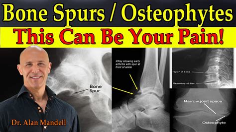 Bone Spursosteophytes This Can Be Your Pain Dr Mandell Youtube