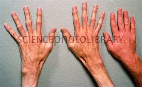 Marfan Syndrome Hand Test 10 Hand Signs Spider Fingers Slideshow