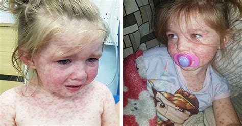 Toddlers Chicken Pox Turns Into ‘worst Case Of Foot And Mouth Disease