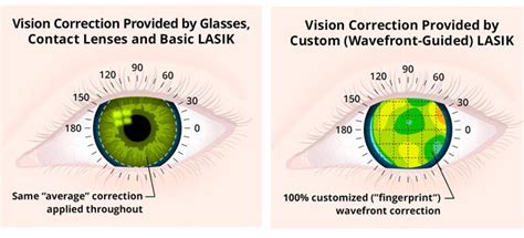 Typical Lasik Eye Surgery Costs In Uk Clinics Laser Eye Surgery Hub