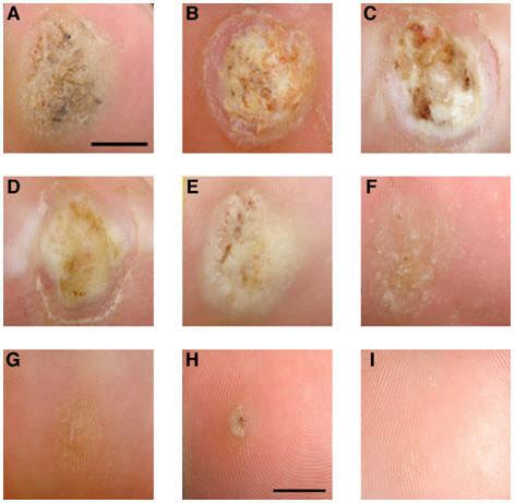 Recalcitrant warts on the scalp and beard areas, resistant to conventional treatments have been successfully treated with. Presentation of recalcitrant plantar warts. Plantar wart ...