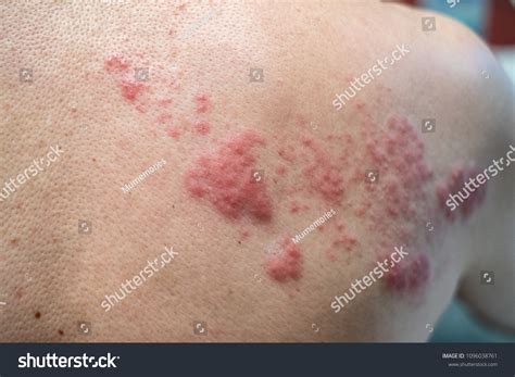 Shingles Disease Herpes Zoster Varicellazoster Virus Stock Photo