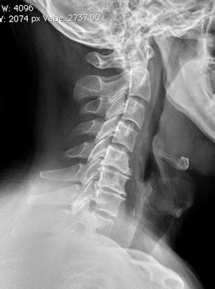Cervical spondylosis is a fancy medical term for osteoarthritis in the neck area of the spine. Cervical Spondylosis - Spine - Orthobullets