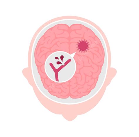 Illustration Of Various Human Brain Strokeshemorrhagic Stroke Disease