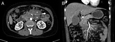 The Sandwich Sign In Abdominal Computed Tomography A Axial View