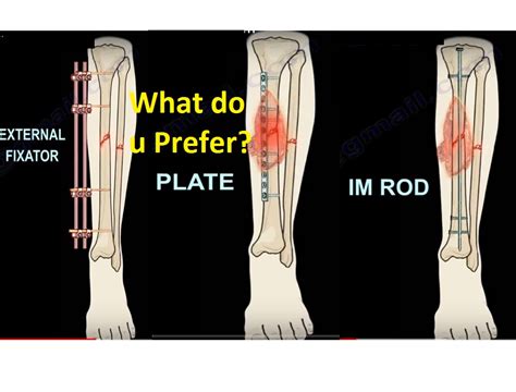 Open Fractures Of The Tibia OrthopaedicPrinciples Com