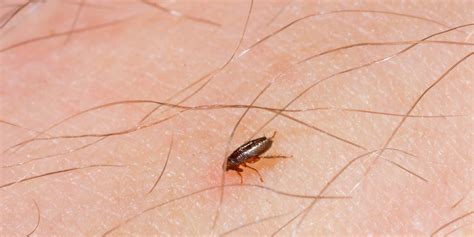 Fleas In Hair Symptoms Make Big Blook Image Archive