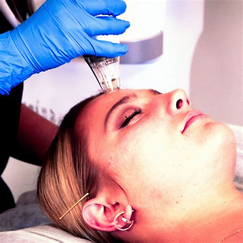 Rf Microneedling For Acne Scar Treatment And Other Skin Concerns Skintech