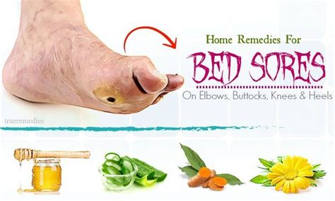 16 Home Remedies For Bed Sores On Elbows Buttocks Knees And Heels