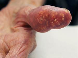 Changing the image of Gout - Atlas of Science Gout  