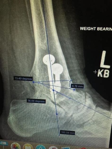 Fibular Resection The Foot And Ankle Online Journal