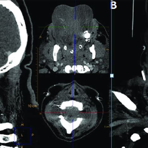 A Neck Ct Enhanced Sagittal Facial View Showed An Important