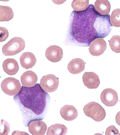 Atypical Reactive Lymphocytes Of Infectious Mono Nucleoasis Caused By