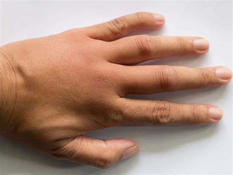 Pictures Of Hand Problems Ericvisser