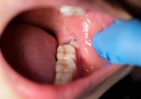 Why Are My Wisdom Teeth Bleeding So Much Causes And Prevention Tips