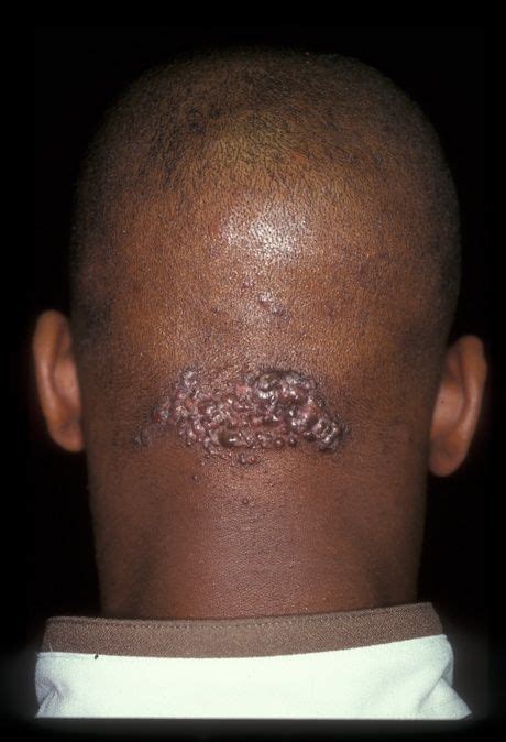 What Can Cause A Lump On The Back Of The Neck Hairline Face Mapping