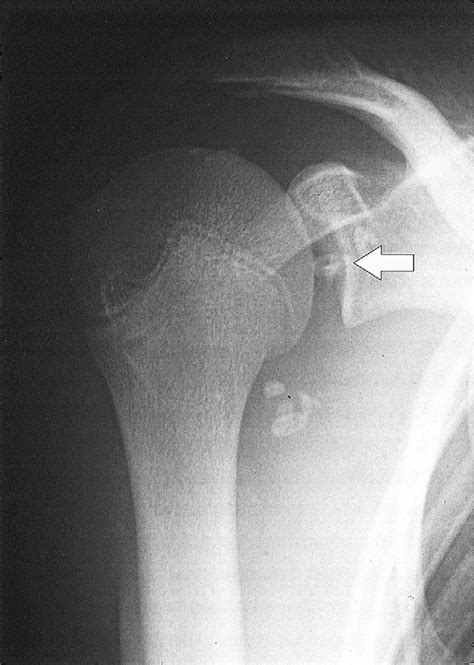 Anteroposterior Radiograph Of Right Shoulder Showing Multiple Calcified