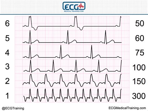 How To Calculate Heart Rate In Ecg Haiper