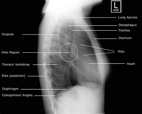 Adult Chest Lateral Radiographic Anatomy Radiographic Anatomy