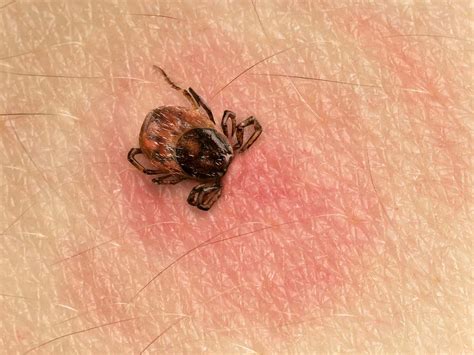 Picture Of Tick Bite Rings Pest Hacks